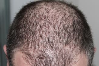 Hair loss in thyroid patient