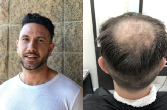 Men hair loss